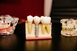 implant dentaire en hongrie